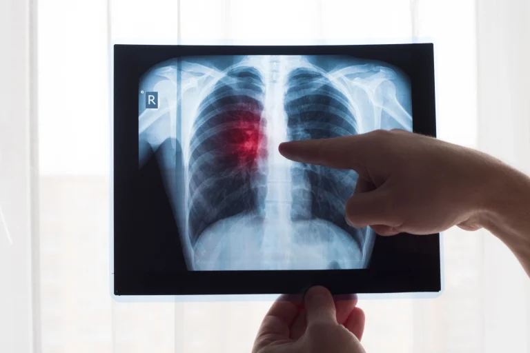 Doctor sosteniendo una radiografia pulmonar con una infección marcado en rojo